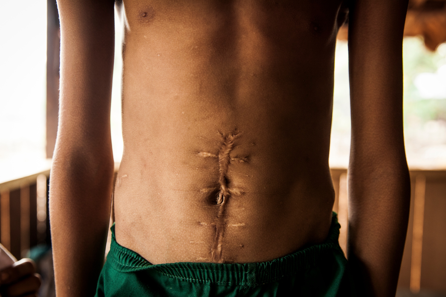 Min Thiya, 10, shows a large scar from injuries he sustained two-years ago when he and a group of his friends were playing with unexploded ordnance that killed his friend So Aung Myo Win instantly and injured four others, including Min, at the Ann Ka Law village in Kayin State in Myanmar, Monday 3 April 2017. In 2017, working with the Government of Myanmar, UNICEF will strive to meet the basic needs of the most vulnerable internally displaced children. Myanmar is experiencing three protracted humanitarian crises, each with its own set of complex underlying factors. In Rakhine State, inter-communal violence that erupted in 2012 continues to plague 120,000 internally displaced people spread across 40 camps or informal sites, as well as host communities. Eighty per cent of the displaced are women and children. In Kachin State, armed conflict that reignited in 2011 continues to impact communities caught in the crossfire between an ethnic armed group and the Myanmar army. Nearly 87,000 people remain displaced as a result, including 40 per cent who are in areas outside of government control. An additional 11,000 people remain displaced in northern Shan State, where a similar conflict oke out in 2011. Compounding the protracted crises are issues related to religious and/or ethnic discrimination, exploitation, chronic poverty, vulnerability to natural disasters, statelessness, trafficking and humanitarian access. In addition to the humanitarian crises in Rakhine, Kachin and Shan states, Myanmar is impacted by humanitarian situations in other parts of the country, including natural disasters, health emergencies and small-scale displacements.